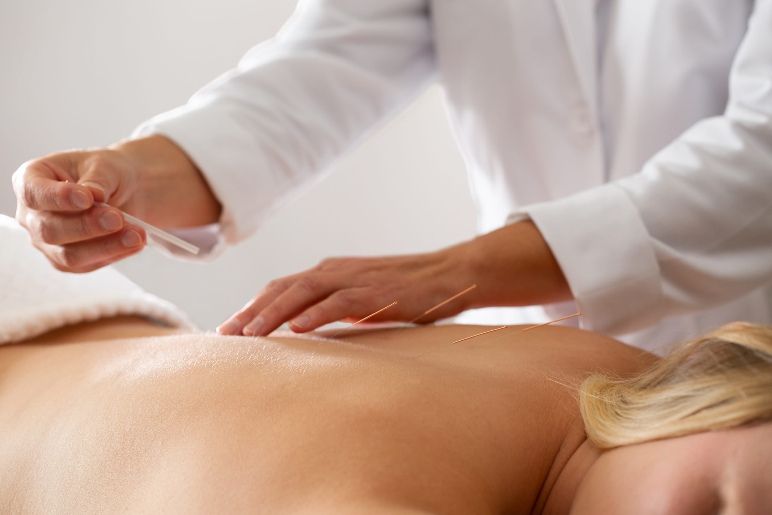 Acupuncture on a wellness retreat in Colorado Springs