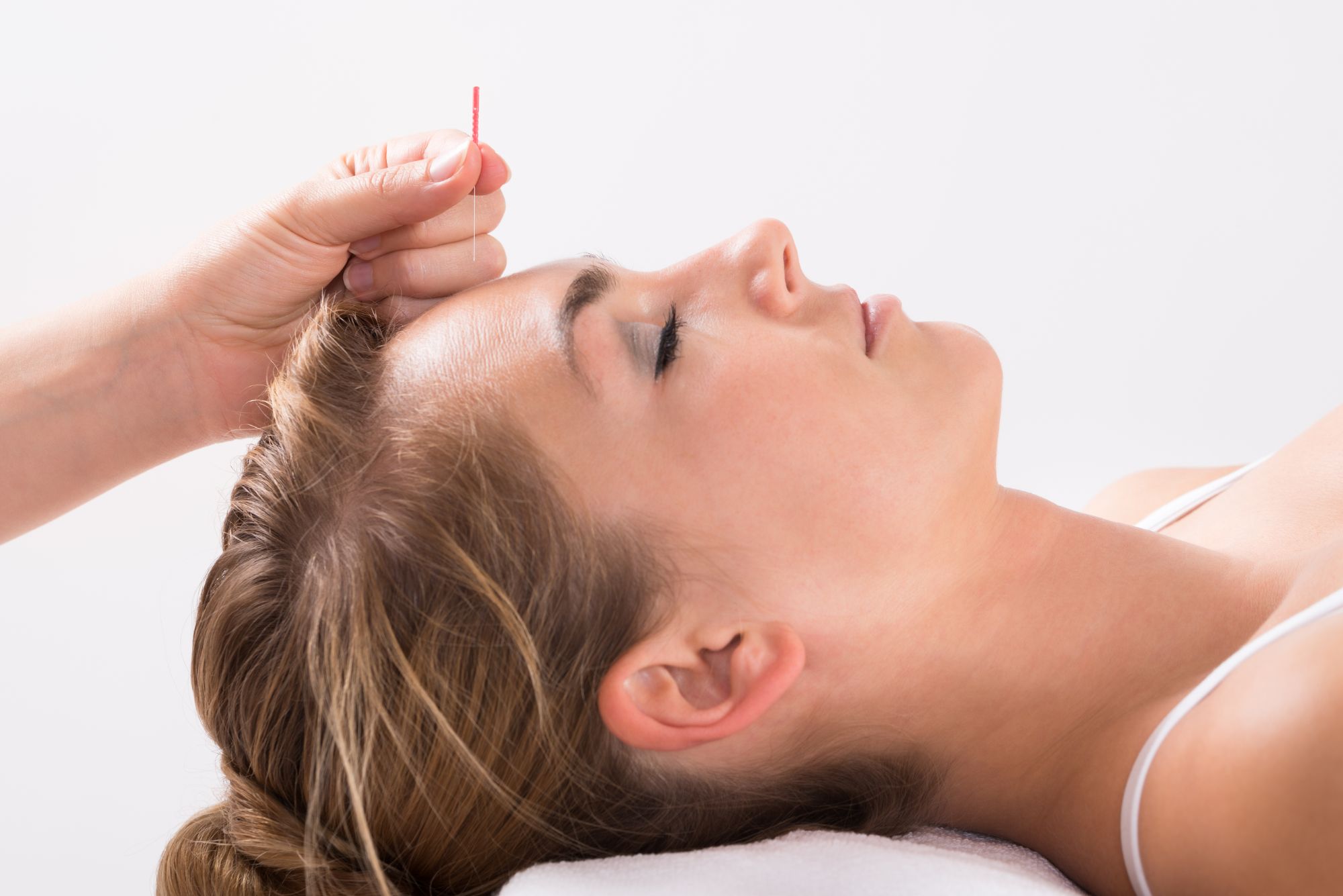 A woman receiving acupuncture treatment therapy at Strata Med